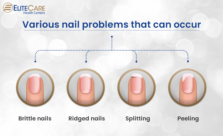 Various Nail Problems That Can Occur