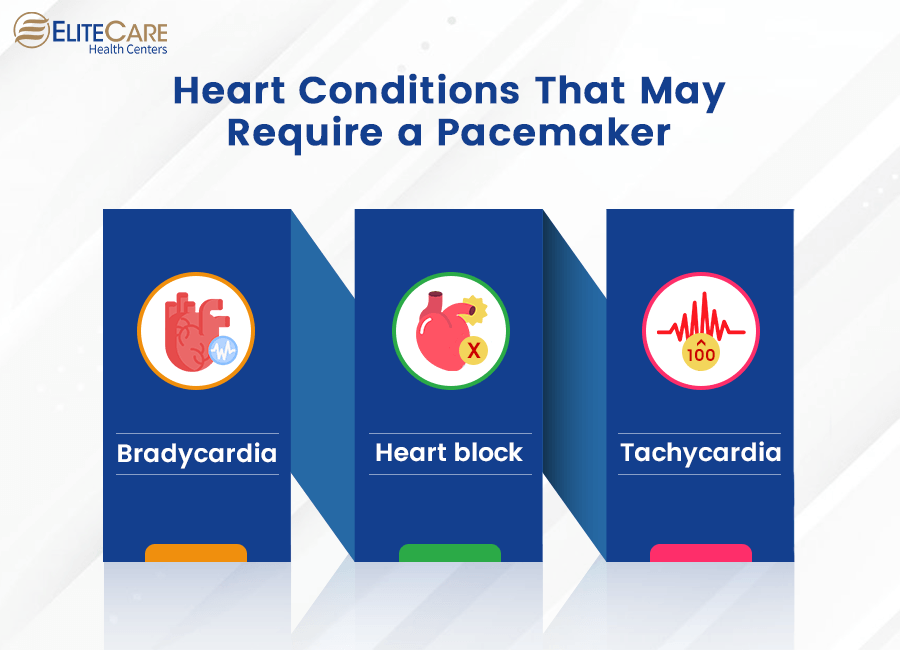 Heart Conditions that May Require a Pacemaker