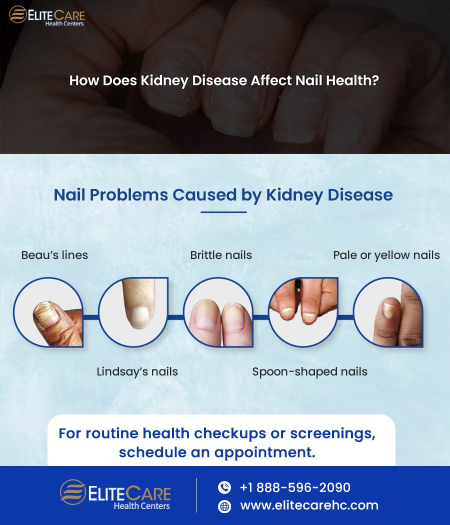 How Does Kidney Disease Affect Nail Health | Infographic