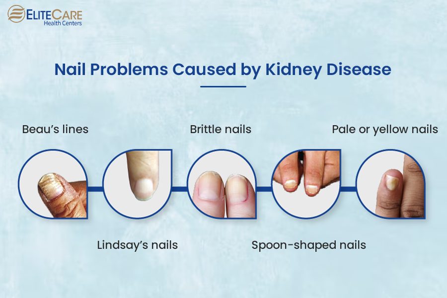 Nail Problems Caused by Kidney Disease