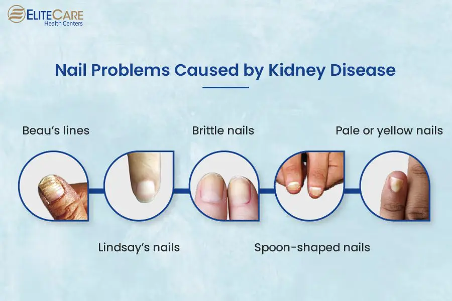 Be Careful, Changes to the Nails of Signs of Disease | Natural antifungal,  Nail health, Health tips