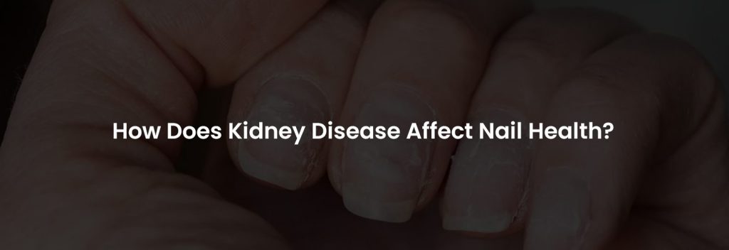 How Does Kidney Disease Affect Nail Health | Banner Image