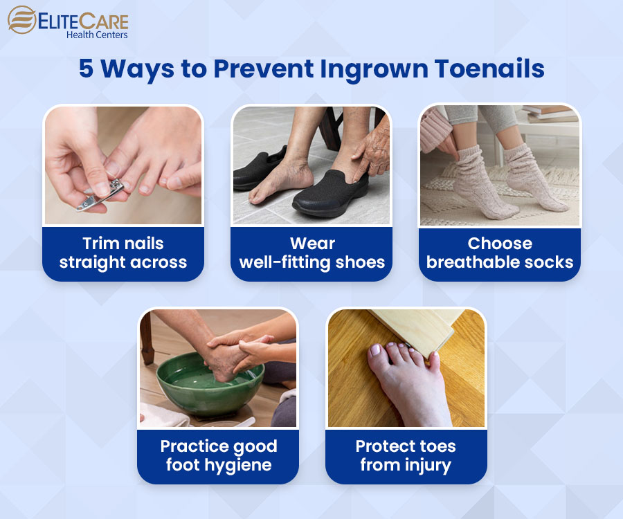 5 Ways to Prevent Ingrown Toenails