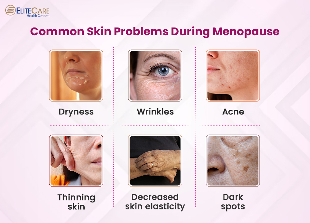 Common Skin Problems During Menopause