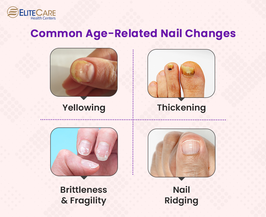 Common – Age Related Nail Changes